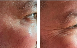 resuts before and after Infuzion System