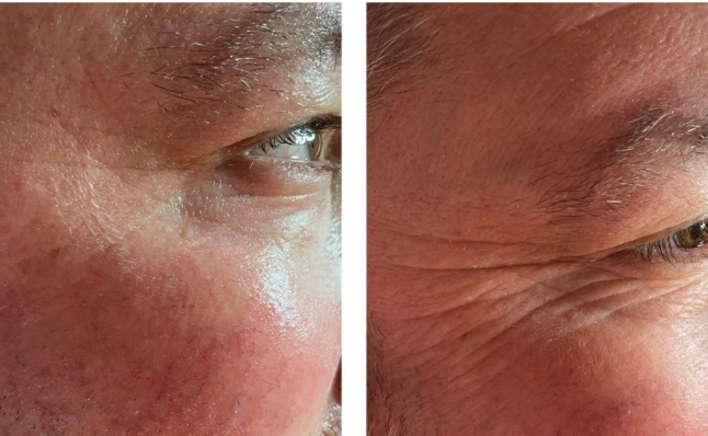 Resultaten avant & après Infuzion System