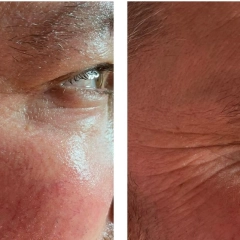 resuts before and after Infuzion System resuts before and after Infuzion System