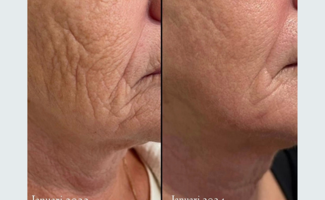 resuts before and after Infuzion System