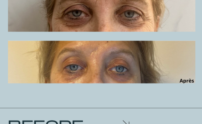 resuts before and after Infuzion System
