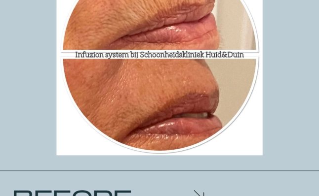 Resultaten avant & après Infuzion System
