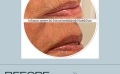 resuts before and after Infuzion System