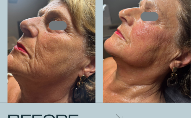 resuts before and after Infuzion System