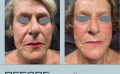 resuts before and after Infuzion System