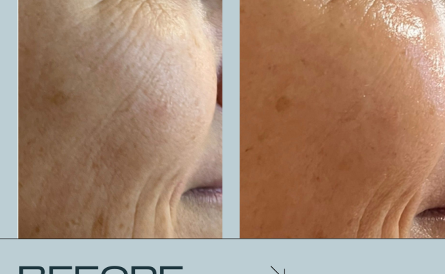 Extra resultaten voor & na met Infuzion System