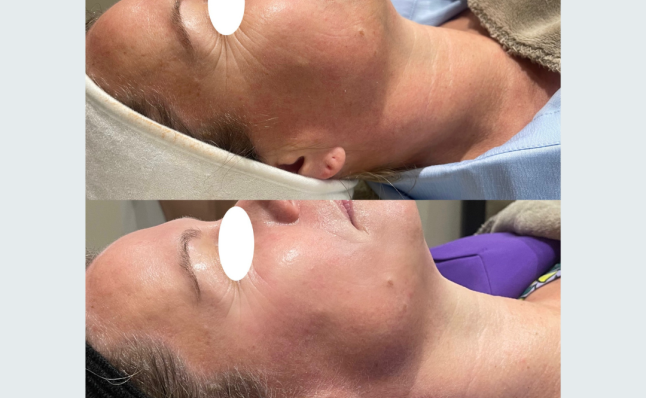 Extra resultaten voor & na met Infuzion System