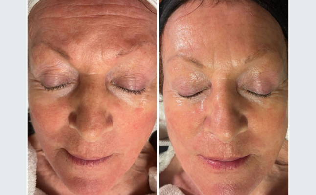 resuts before and after Infuzion System