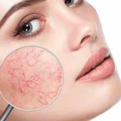 Kan Infuzion System de behandeling van couperose verbeteren? Kan Infuzion System de behandeling van couperose verbeteren?