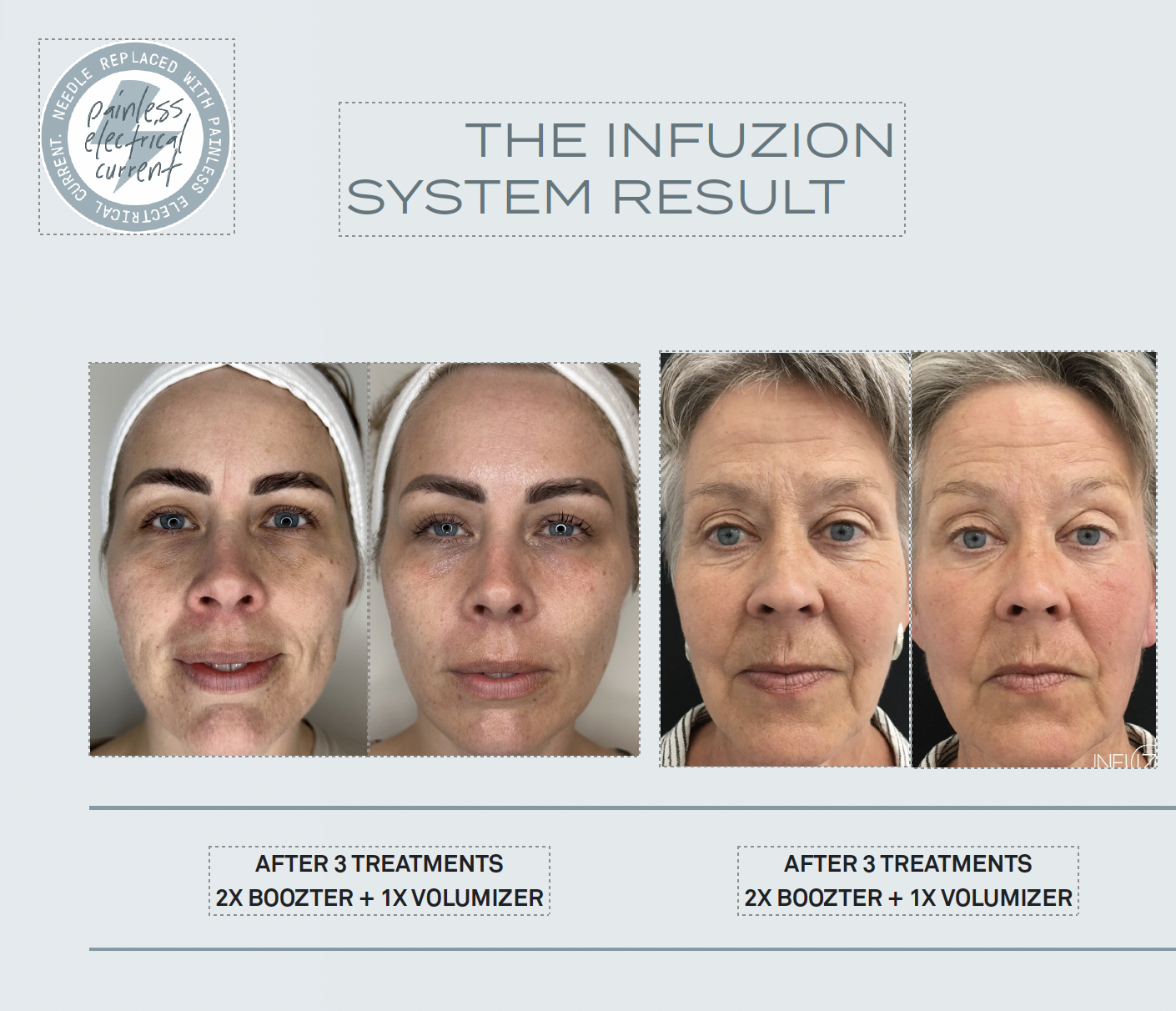 protocol Volymizer serum Infuzion System