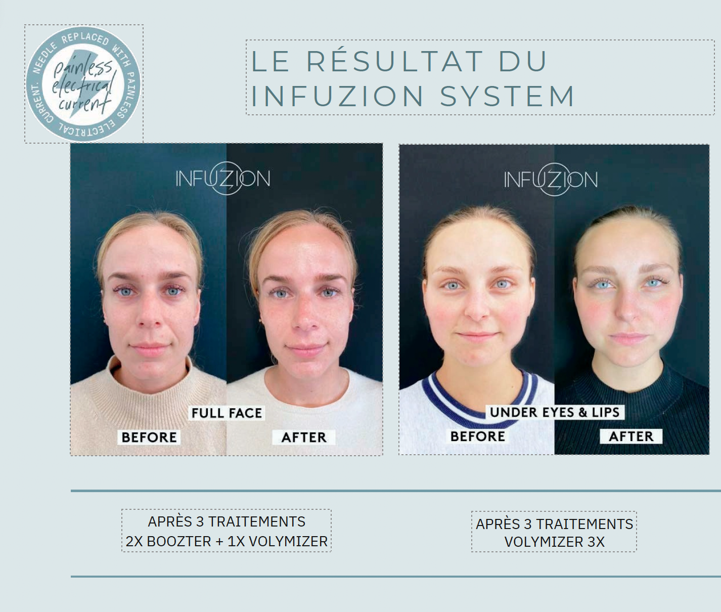 protocol Volymizer serum Infuzion System