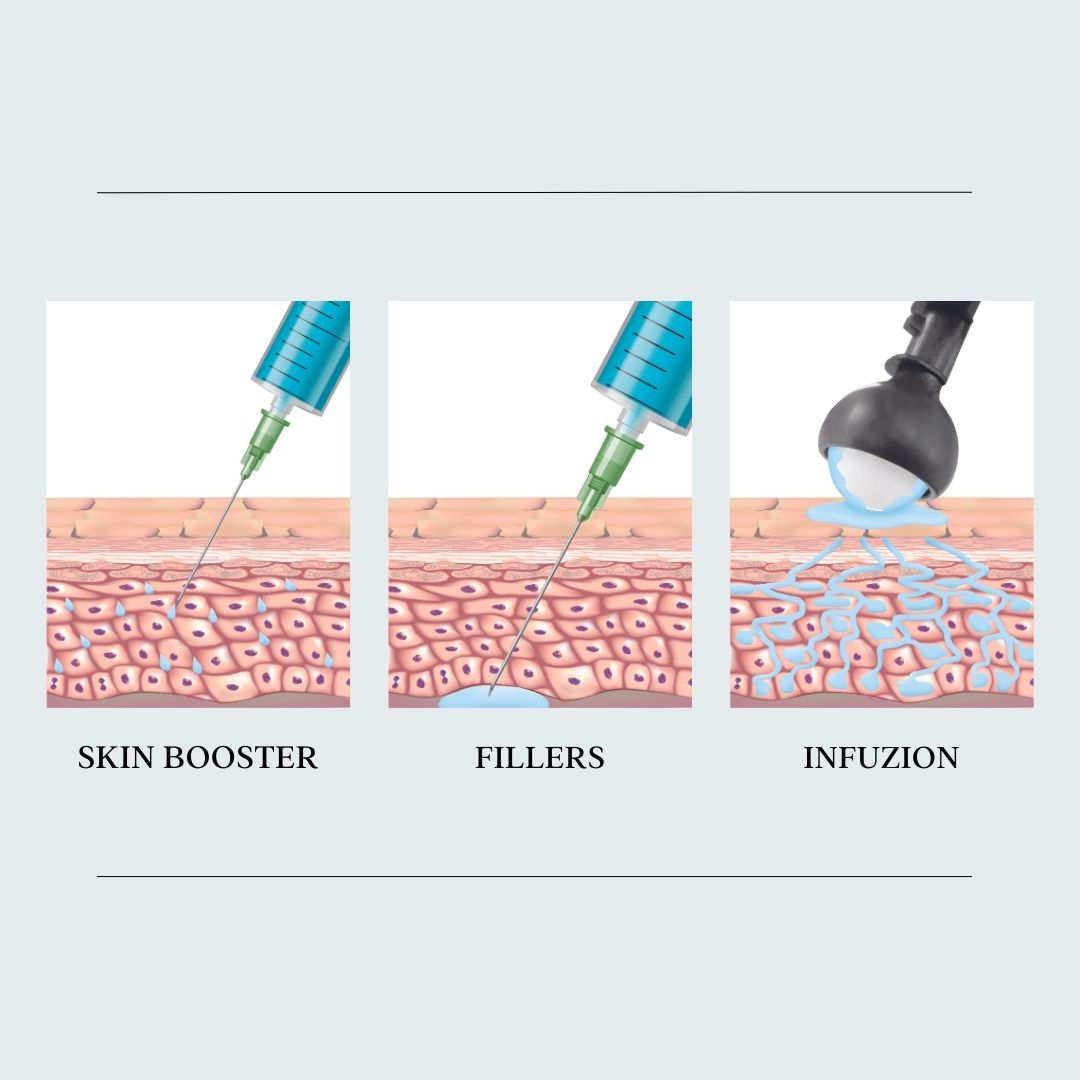 Verschil infuzion filler booster